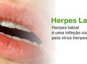 herpes