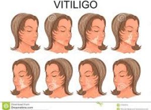 vitiligo